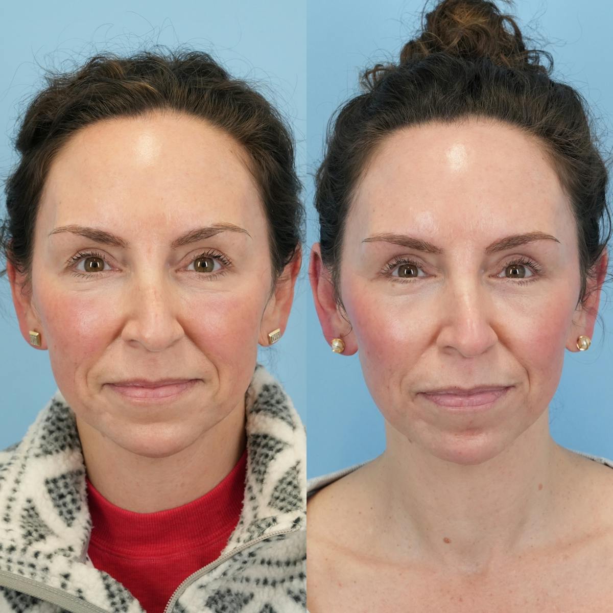 Lower Eyelids Before & After Gallery - Patient 244291 - Image 5