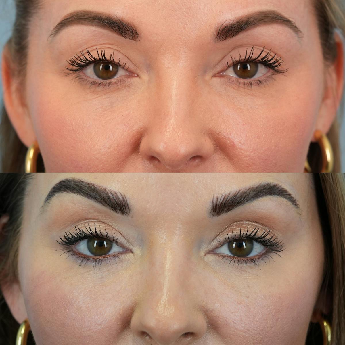 Fat Grafting Before & After Gallery - Patient 332244 - Image 2