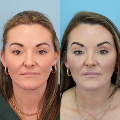 Fat Grafting Before & After Gallery - Patient 332244 - Image 1