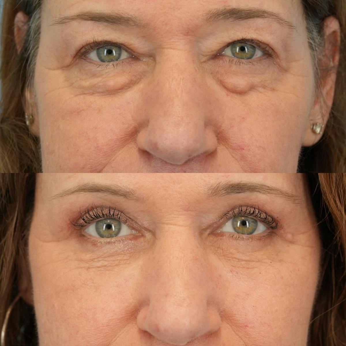 Upper Eyelids Before & After Gallery - Patient 219701 - Image 1