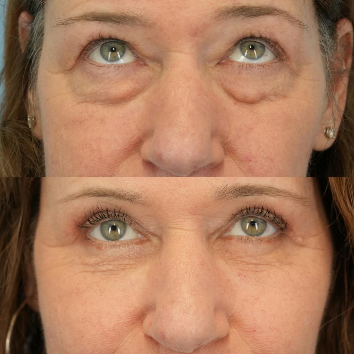 Upper Eyelids Before & After Gallery - Patient 219701 - Image 2