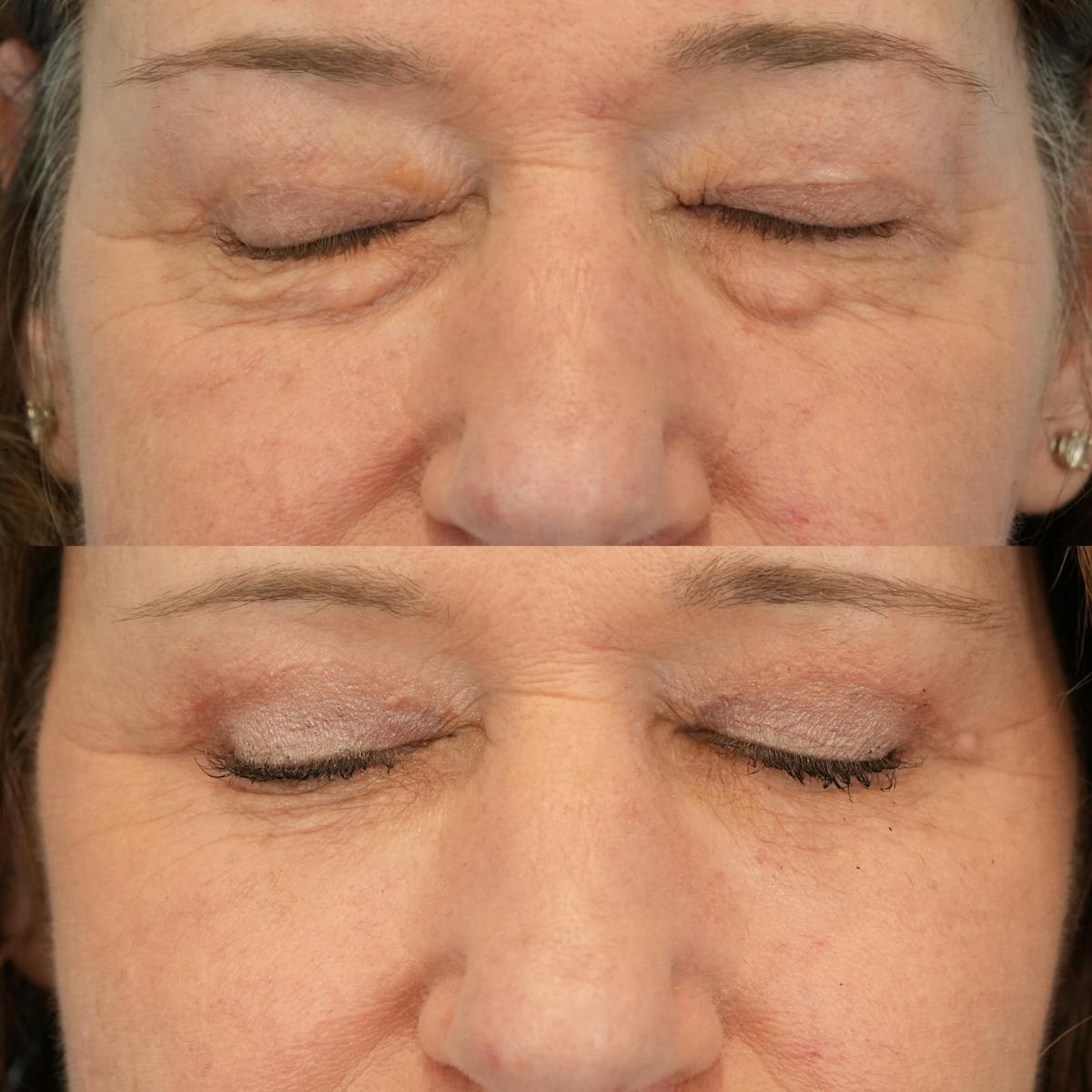 Upper Eyelids Before & After Gallery - Patient 219701 - Image 3
