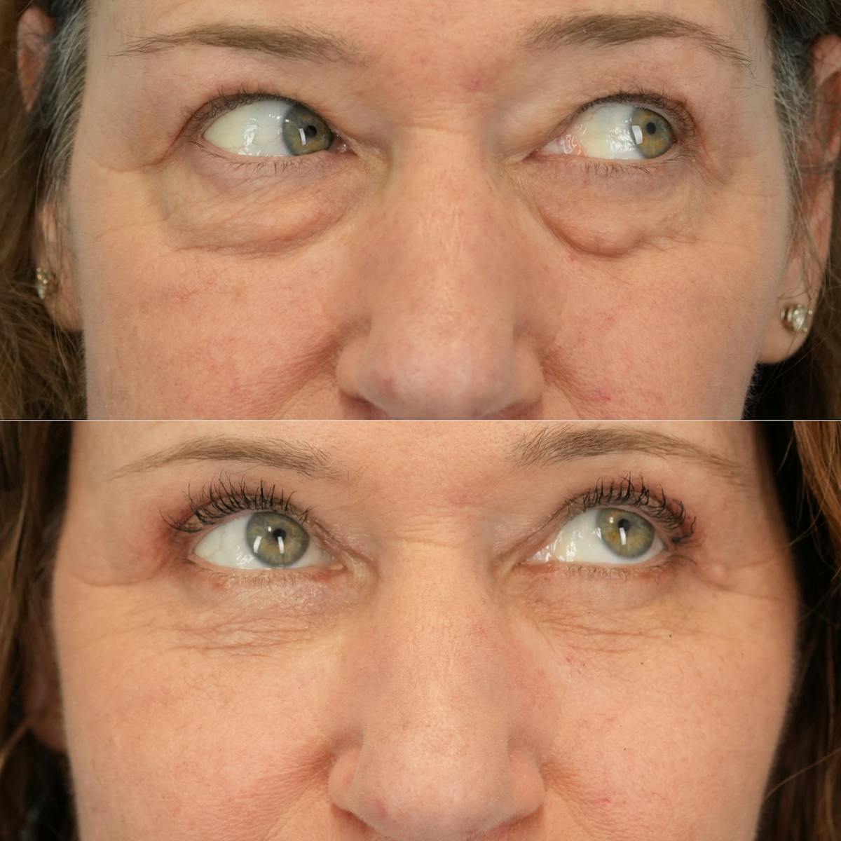 Upper Eyelids Before & After Gallery - Patient 219701 - Image 4