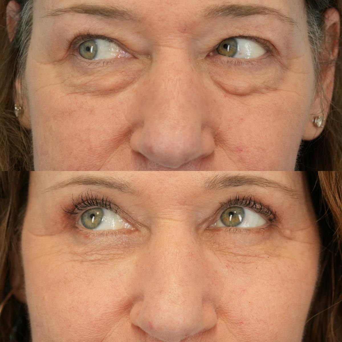 Upper Eyelids Before & After Gallery - Patient 219701 - Image 5
