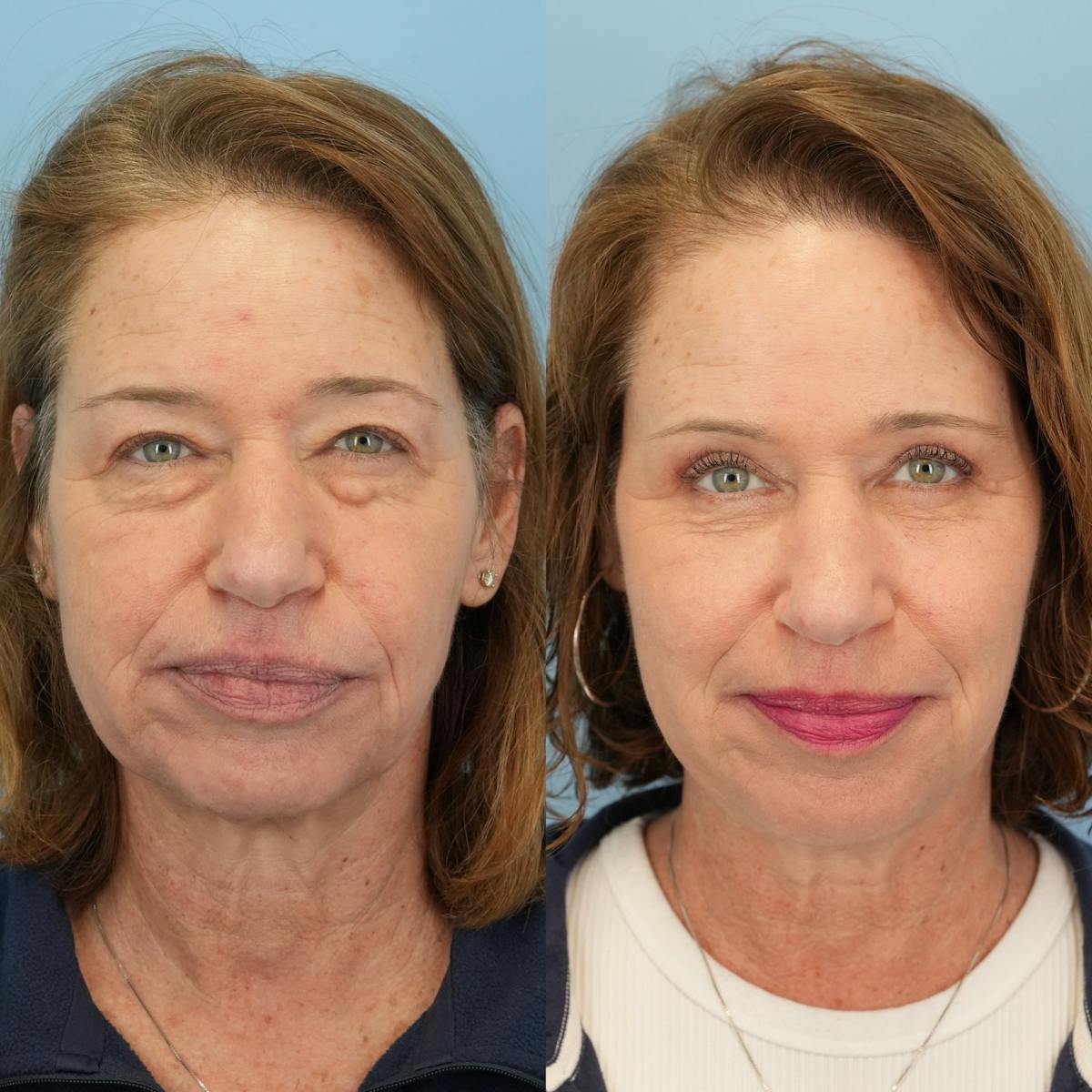 Upper Eyelids Before & After Gallery - Patient 219701 - Image 6