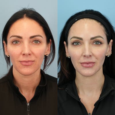 Fat Grafting Before & After Gallery - Patient 255636 - Image 1