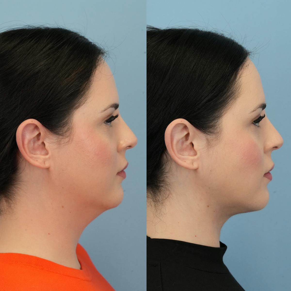 Buccal Fat Excision Before & After Gallery - Patient 982954 - Image 5