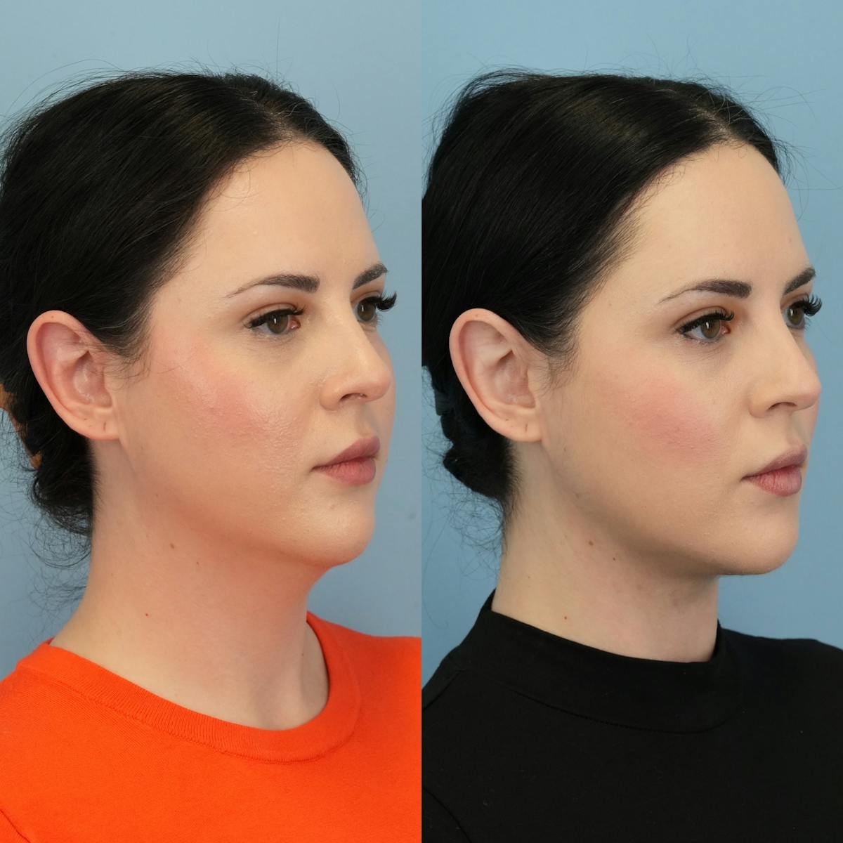 Buccal Fat Excision Before & After Gallery - Patient 982954 - Image 4