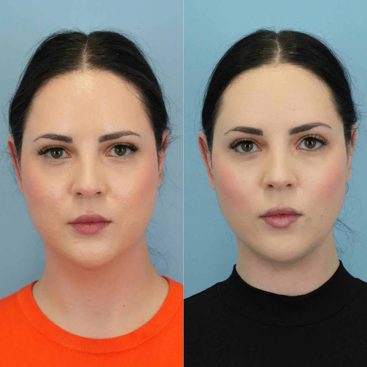 Buccal Fat Excision Before & After Gallery - Patient 982954 - Image 3