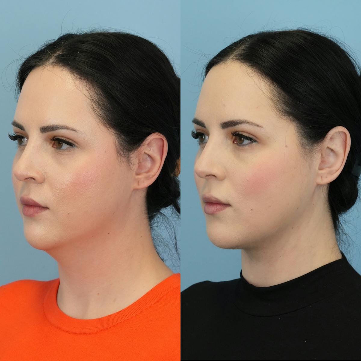 Buccal Fat Excision Before & After Gallery - Patient 982954 - Image 1