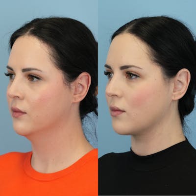 Buccal Fat Excision Before & After Gallery - Patient 982954 - Image 1