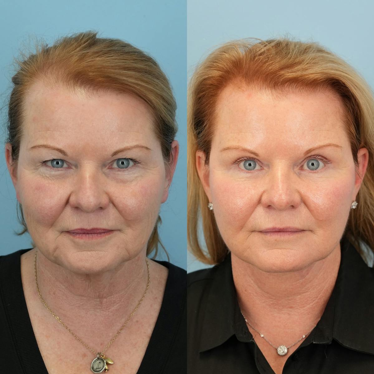 Facelift Before & After Gallery - Patient 351774 - Image 1