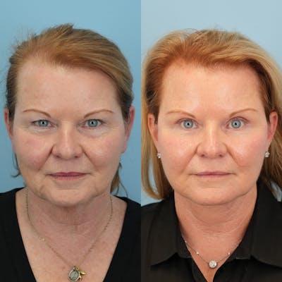 Facelift Before & After Gallery - Patient 351774 - Image 1