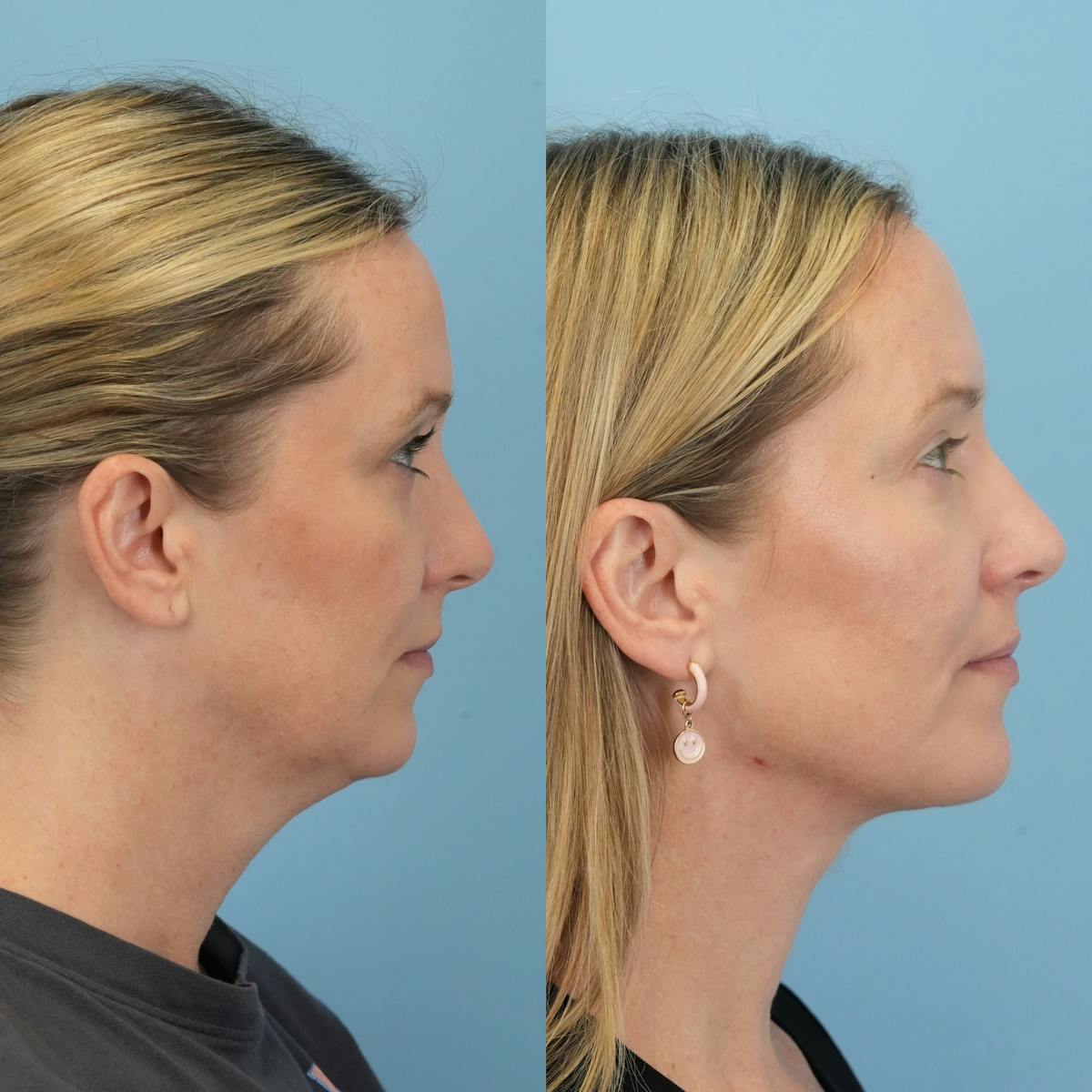 Neck Lift Before & After Gallery - Patient 387781 - Image 1