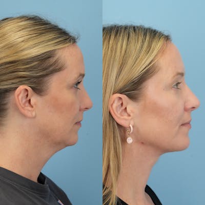 Neck Lift Before & After Gallery - Patient 387781 - Image 1