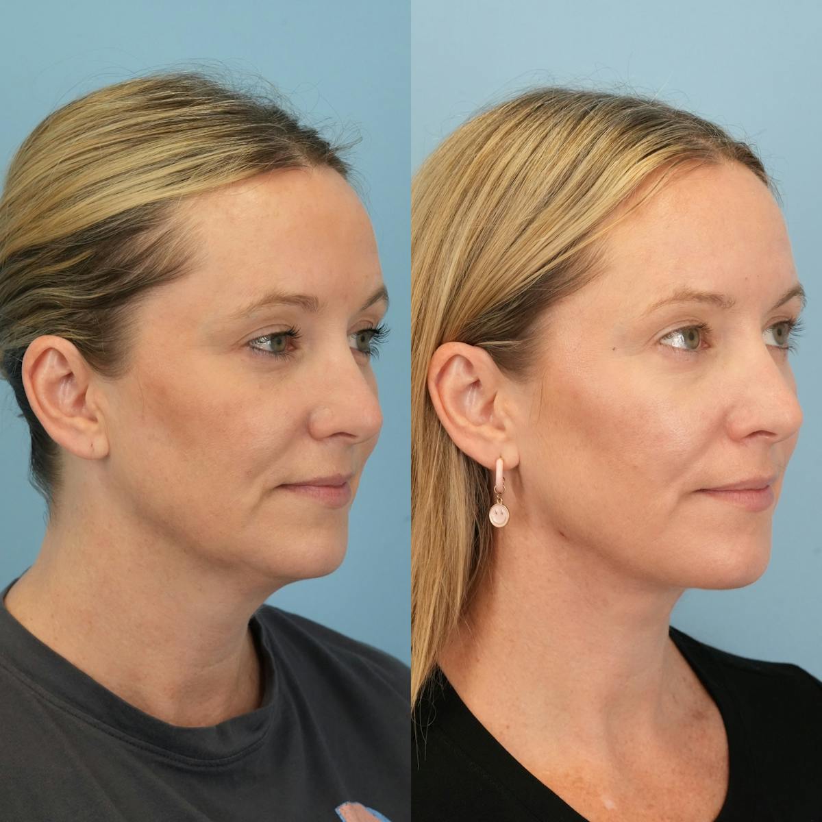 Neck Lift Before & After Gallery - Patient 387781 - Image 2