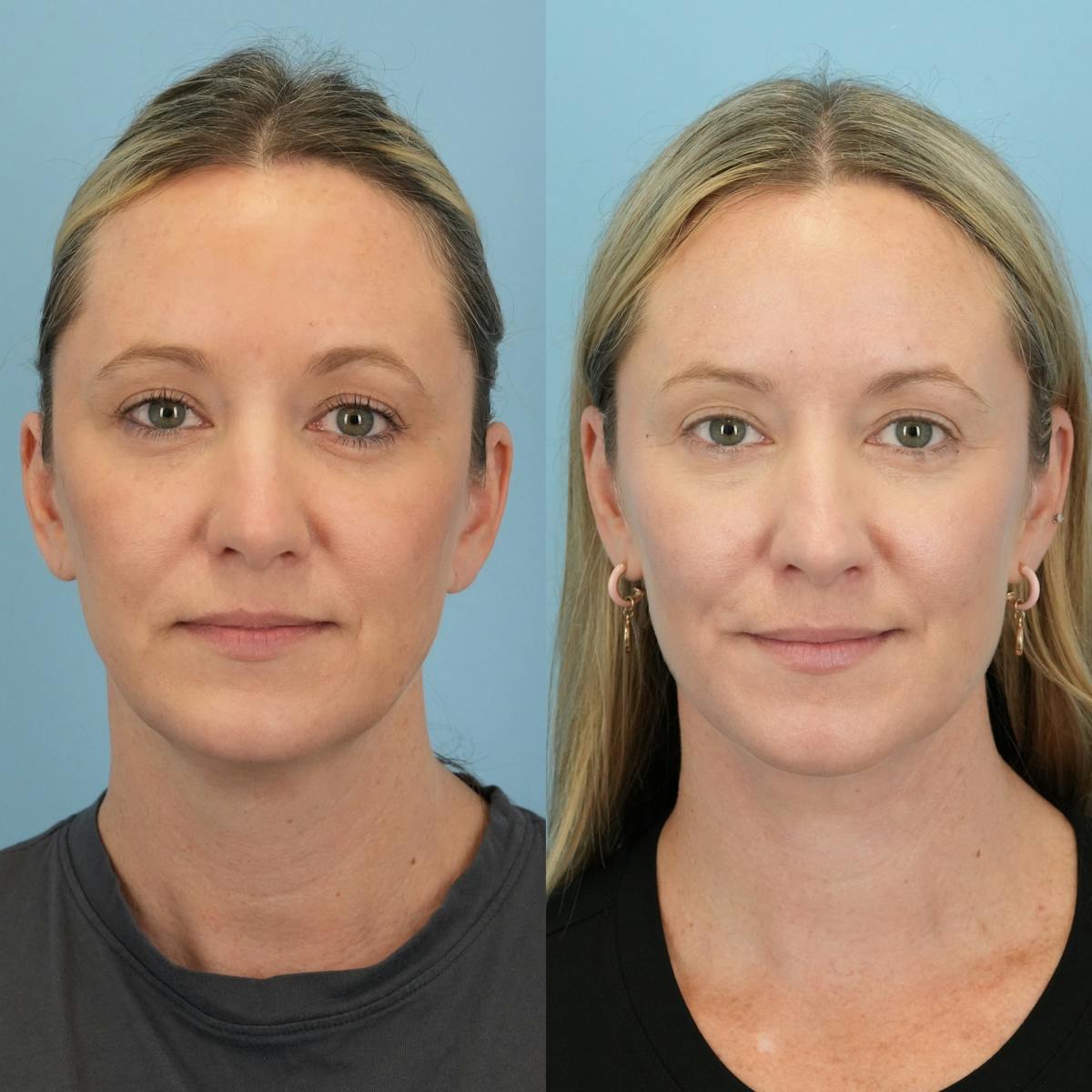 Neck Lift Before & After Gallery - Patient 387781 - Image 3