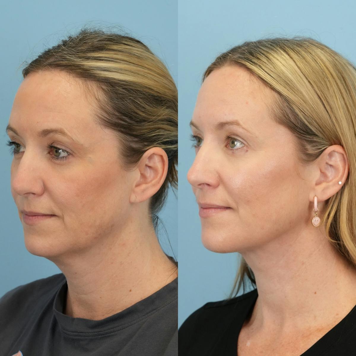 Neck Lift Before & After Gallery - Patient 387781 - Image 4
