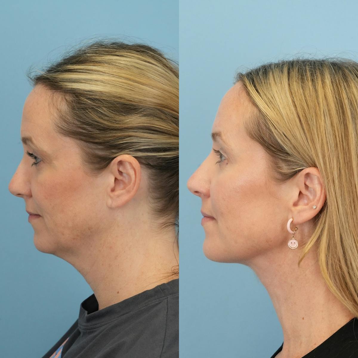 Neck Lift Before & After Gallery - Patient 387781 - Image 5