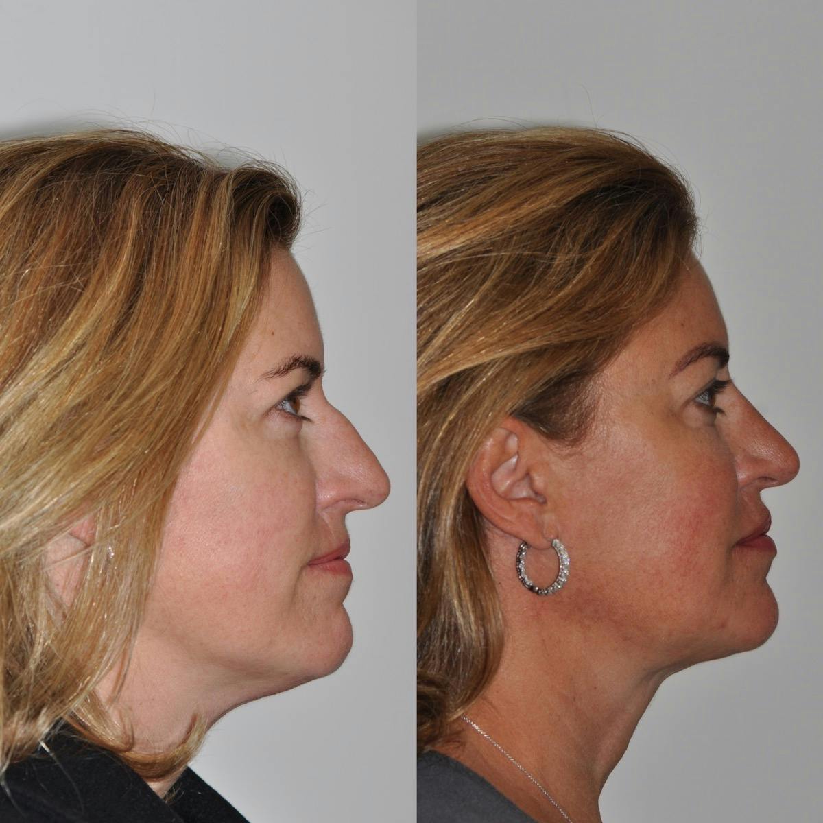 Neck Lift Before & After Gallery - Patient 641985 - Image 1