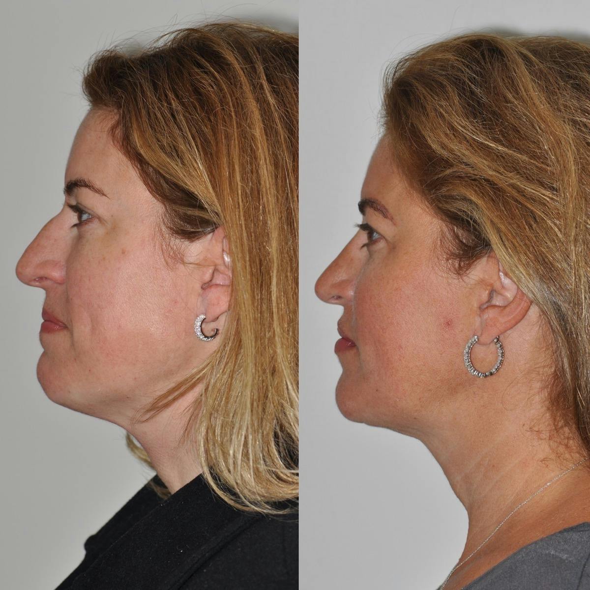 Neck Lift Before & After Gallery - Patient 641985 - Image 2
