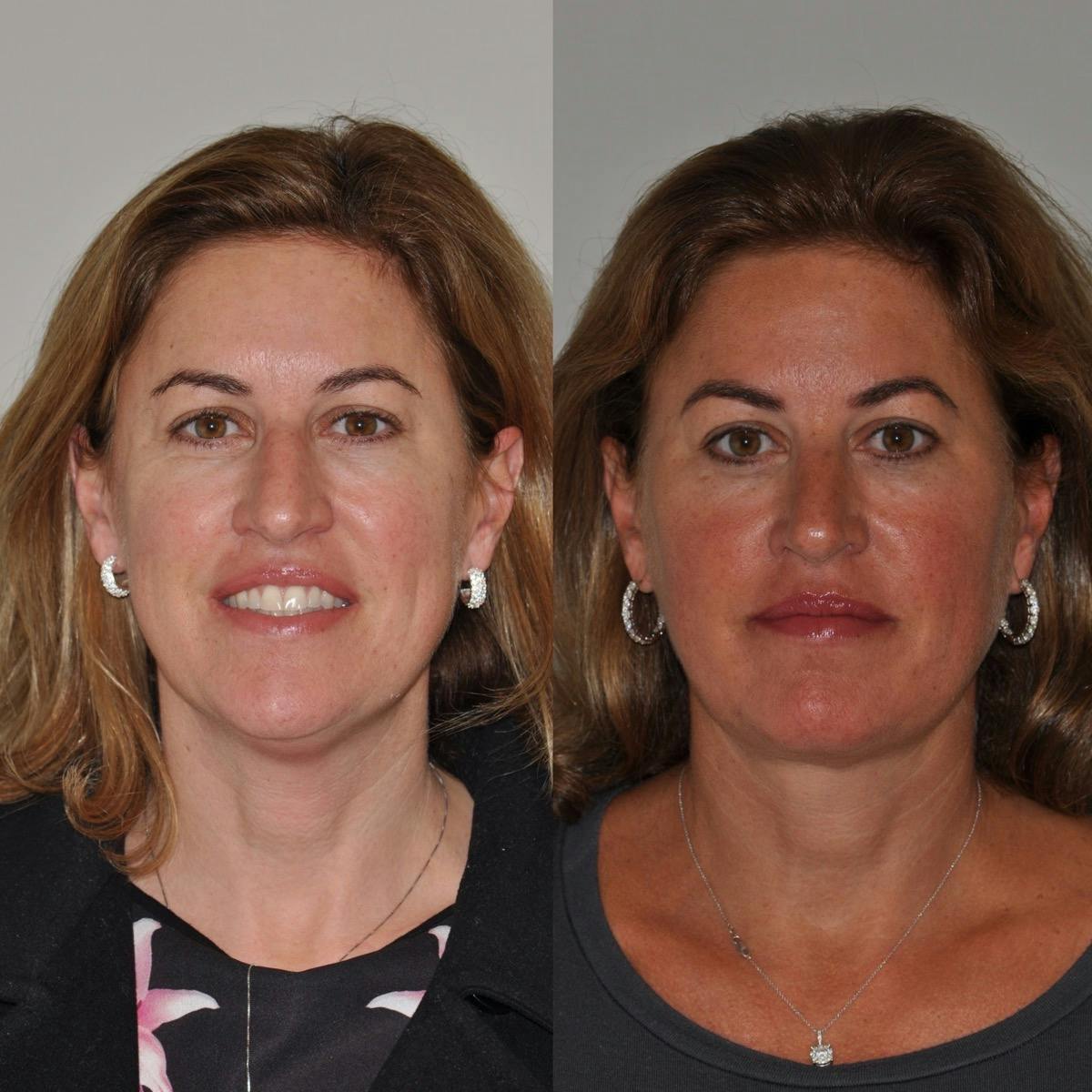 Neck Lift Before & After Gallery - Patient 641985 - Image 3