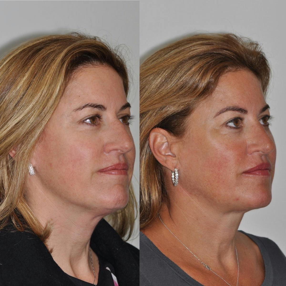 Neck Lift Before & After Gallery - Patient 641985 - Image 4