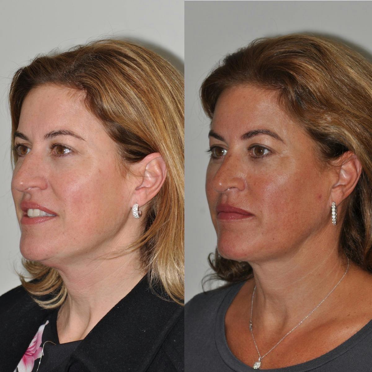 Neck Lift Before & After Gallery - Patient 641985 - Image 5