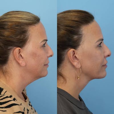 Neck Lift Before & After Gallery - Patient 456233 - Image 1