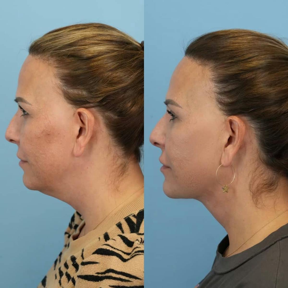 Neck Lift Before & After Gallery - Patient 456233 - Image 2