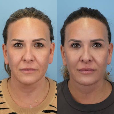 Upper Eyelids Before & After Gallery - Patient 399973 - Image 1