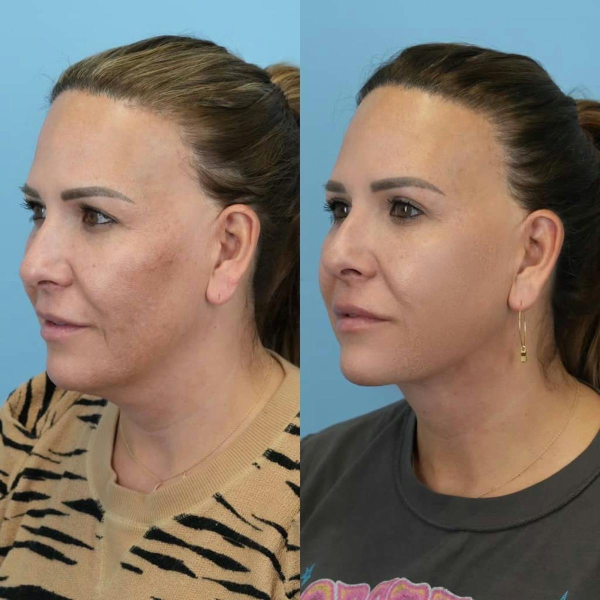 Neck Lift Before & After Gallery - Patient 456233 - Image 4