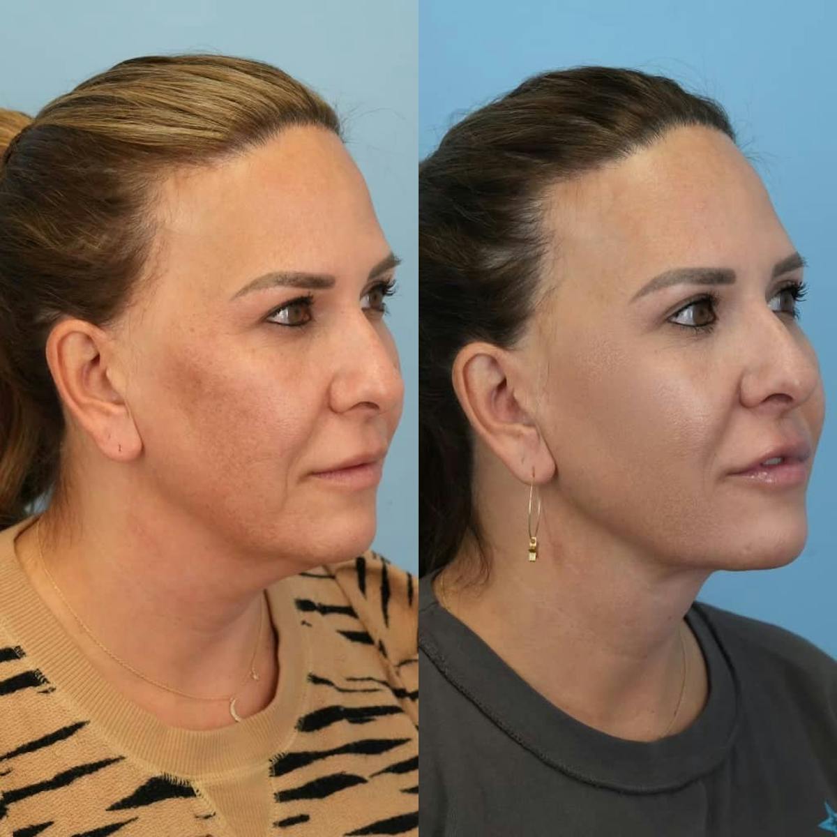 Neck Lift Before & After Gallery - Patient 456233 - Image 5