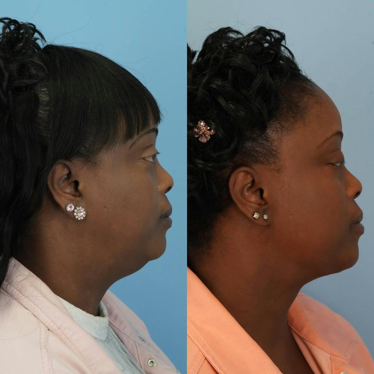 Neck Lift Before & After Gallery - Patient 128146 - Image 1