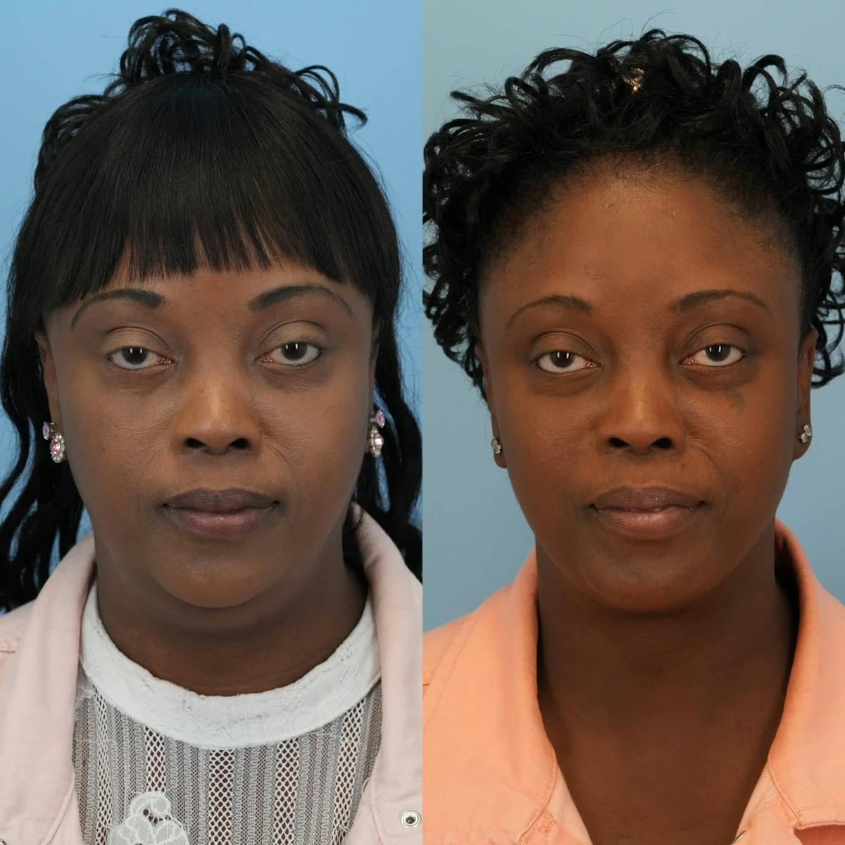 Neck Lift Before & After Gallery - Patient 128146 - Image 3