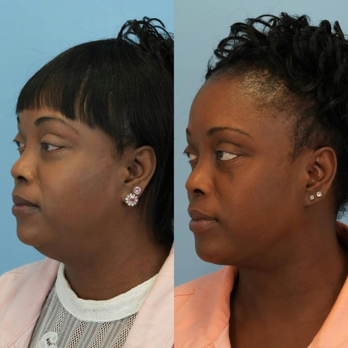 Neck Lift Before & After Gallery - Patient 128146 - Image 4