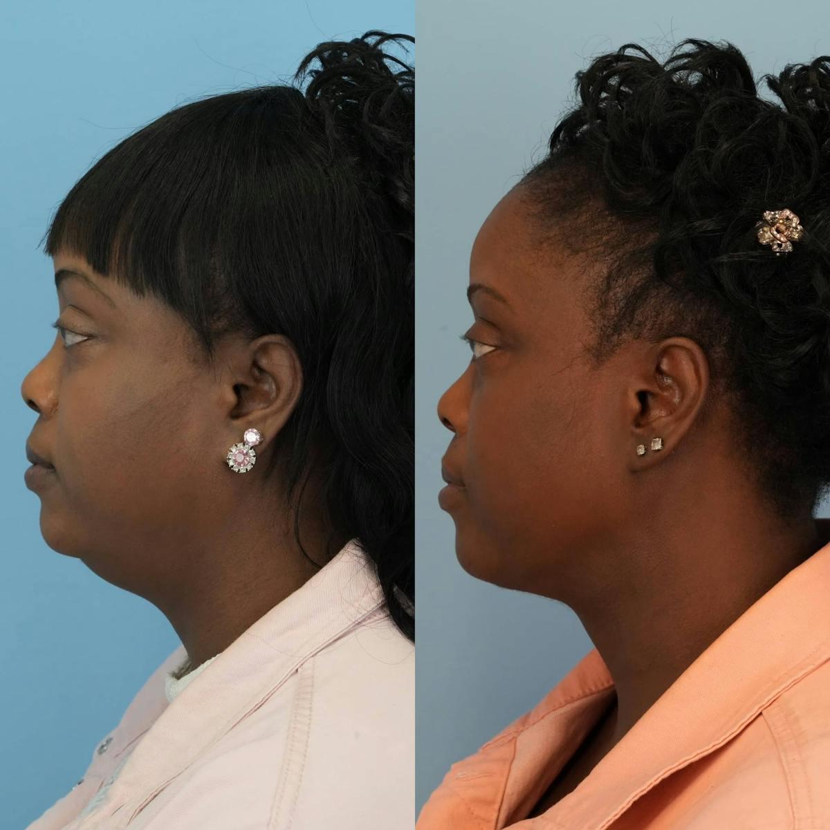 Neck Lift Before & After Gallery - Patient 128146 - Image 5
