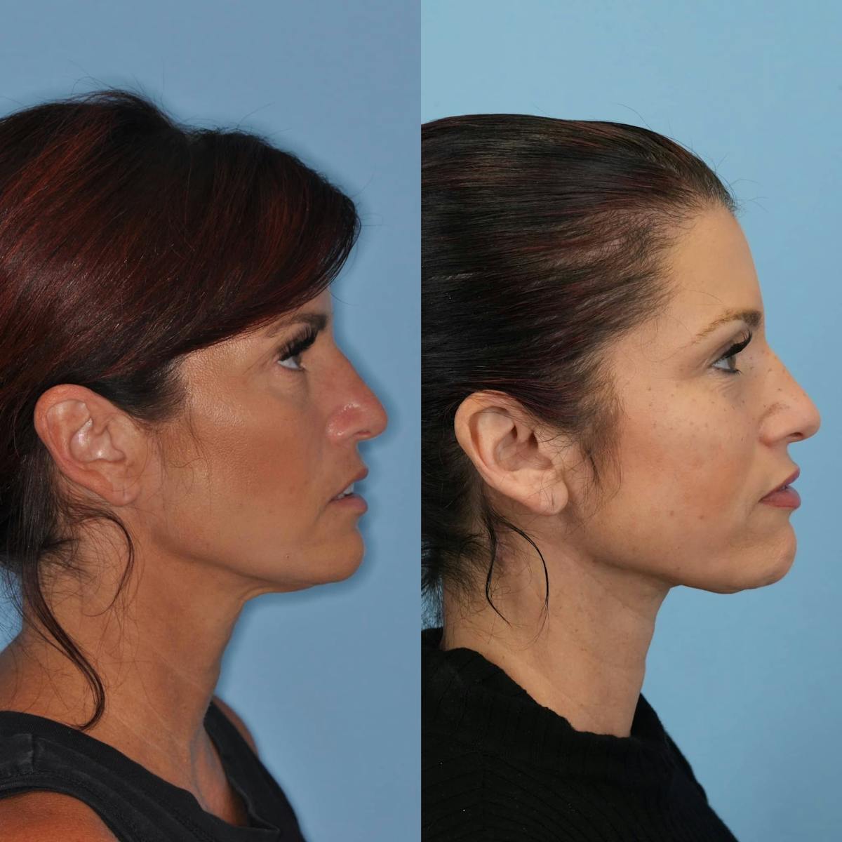 Neck Lift Before & After Gallery - Patient 157908 - Image 1