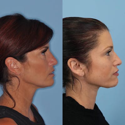 Neck Lift Before & After Gallery - Patient 157908 - Image 1