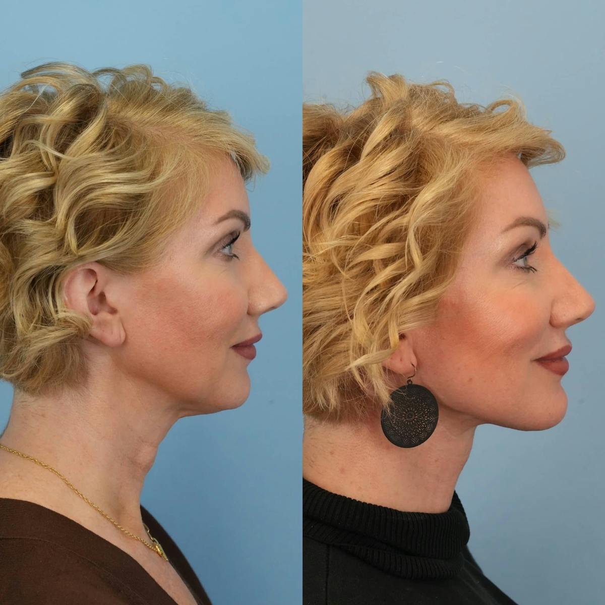 Neck Lift Before & After Gallery - Patient 392053 - Image 1