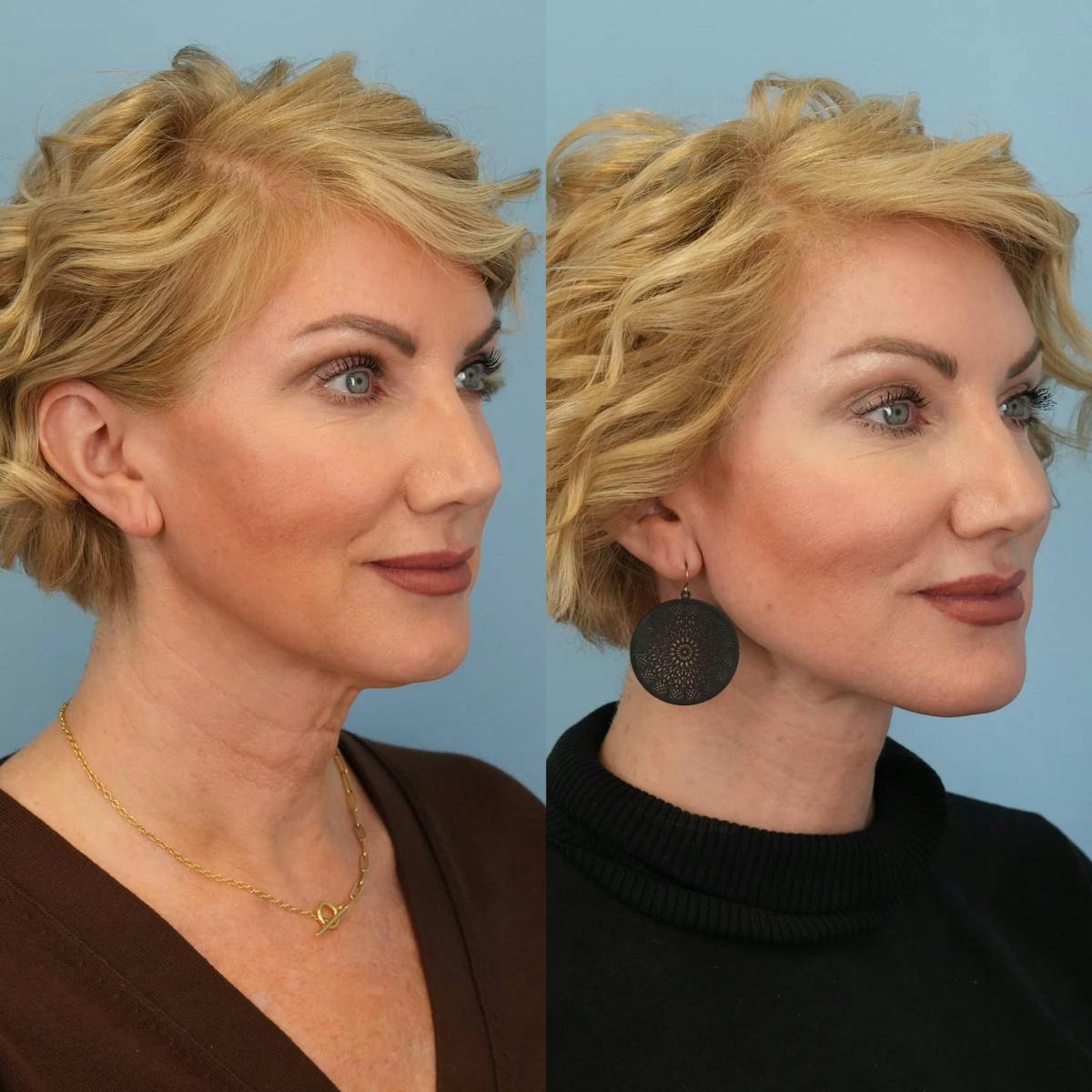 Neck Lift Before & After Gallery - Patient 392053 - Image 2