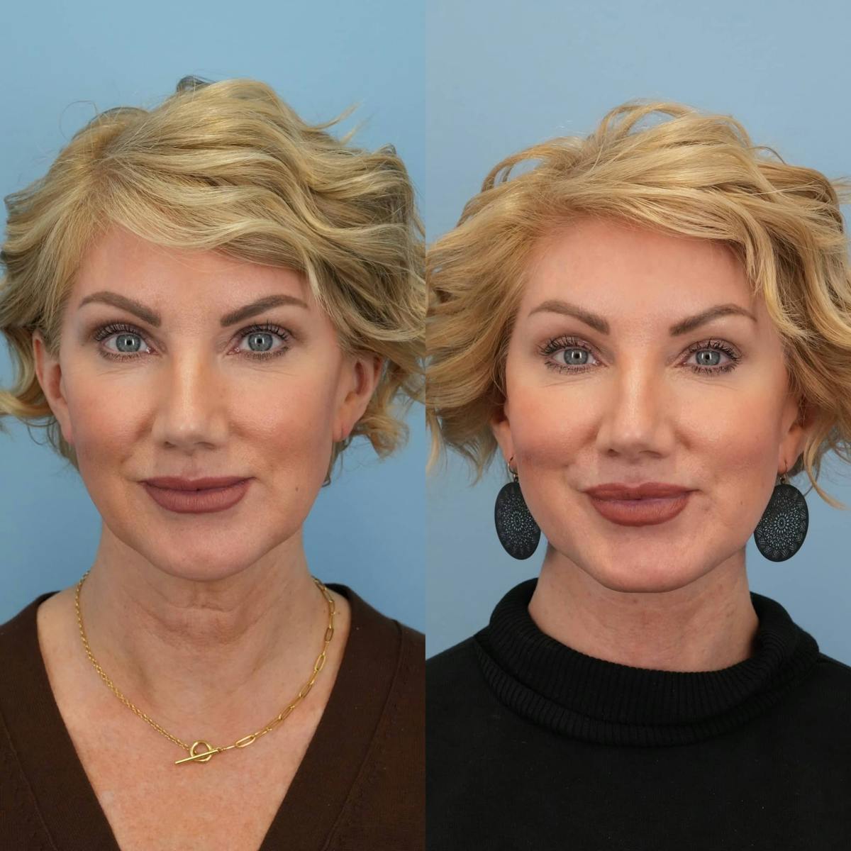 Neck Lift Before & After Gallery - Patient 392053 - Image 3
