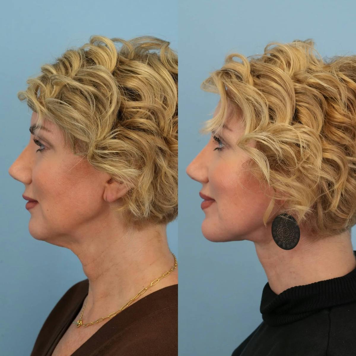 Neck Lift Before & After Gallery - Patient 392053 - Image 4
