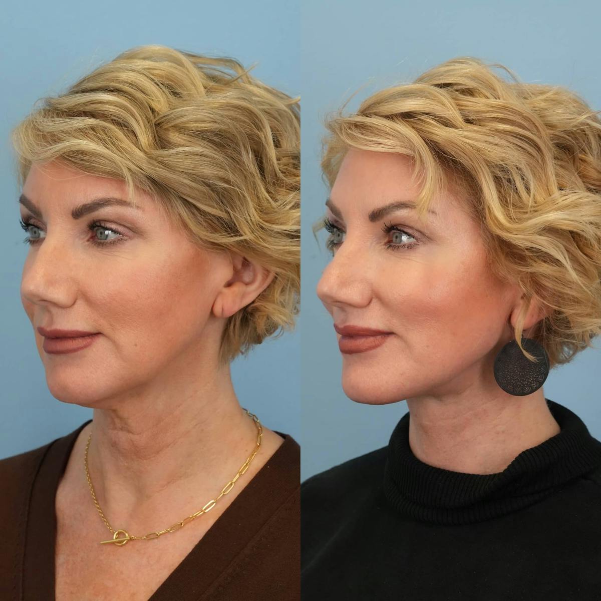 Neck Lift Before & After Gallery - Patient 392053 - Image 5