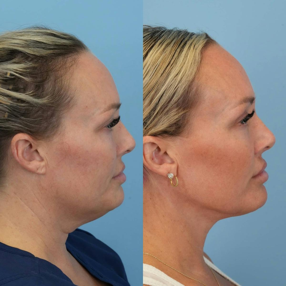 Neck Lift Before & After Gallery - Patient 385548 - Image 1