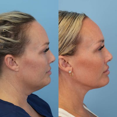 Neck Lift Before & After Gallery - Patient 385548 - Image 1