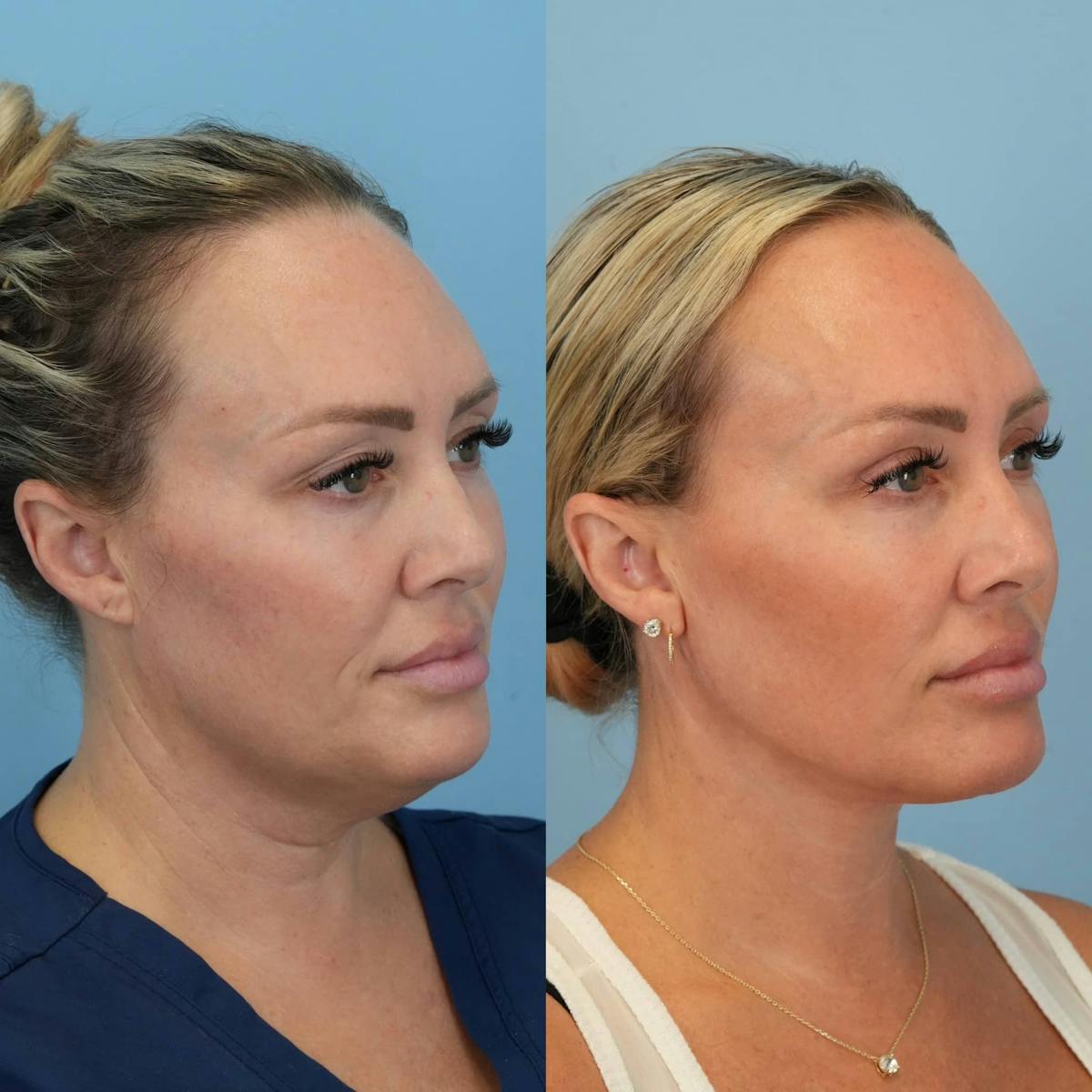 Neck Lift Before & After Gallery - Patient 385548 - Image 2