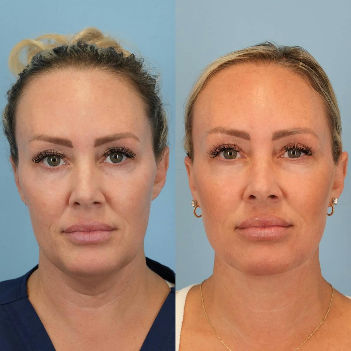 Neck Lift Before & After Gallery - Patient 385548 - Image 3