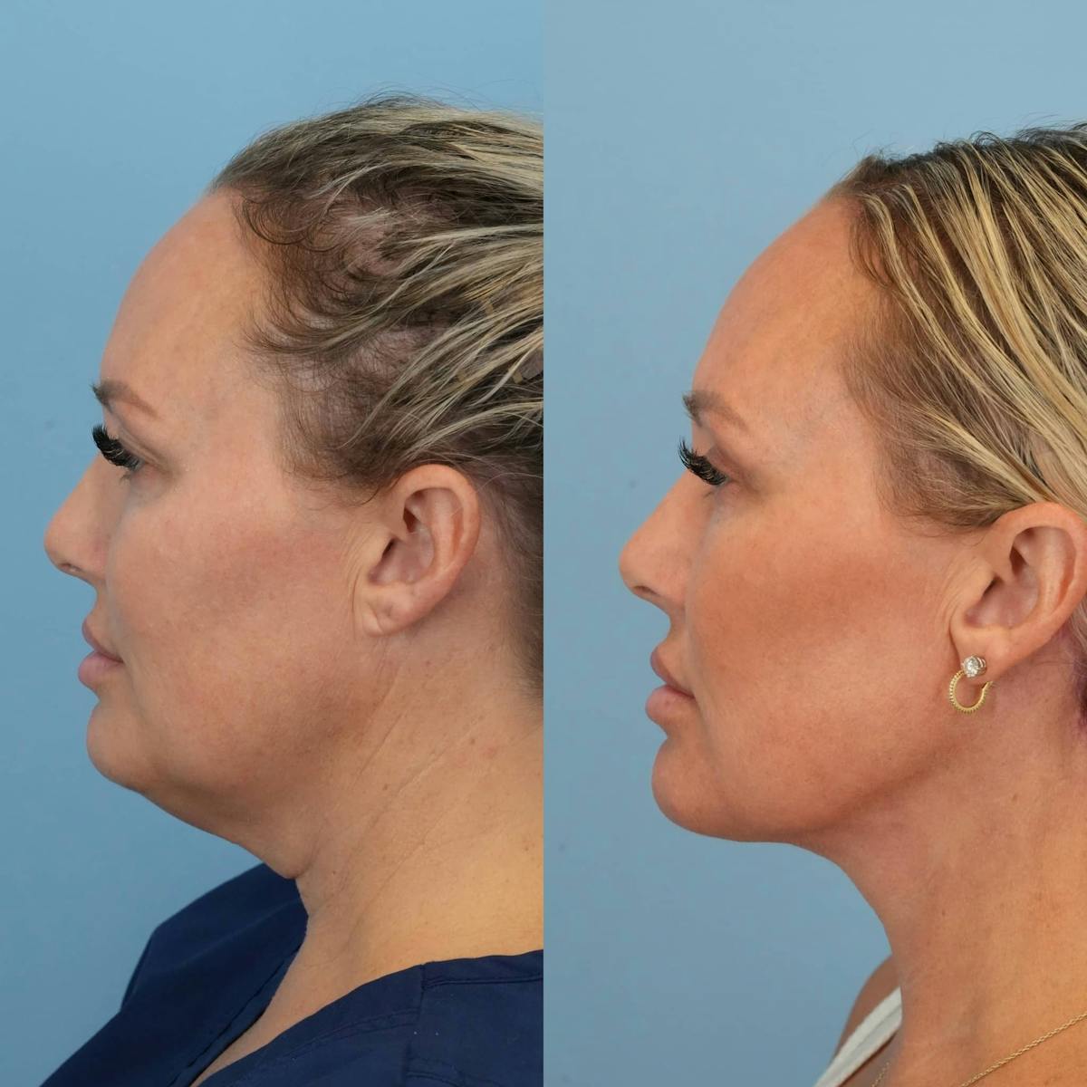 Neck Lift Before & After Gallery - Patient 385548 - Image 4
