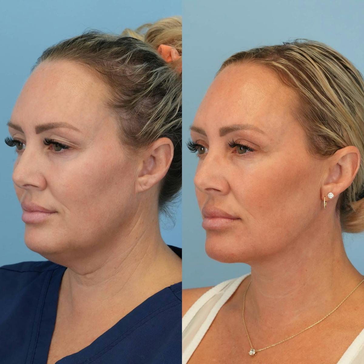 Neck Lift Before & After Gallery - Patient 385548 - Image 5